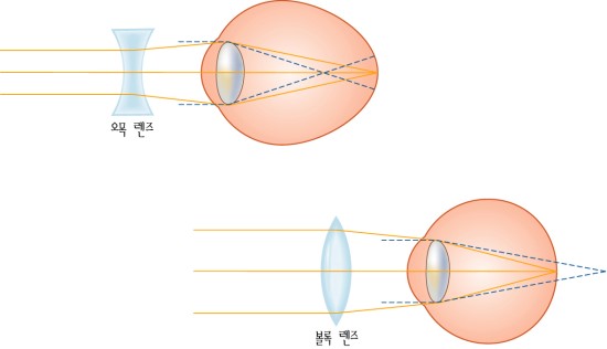 엠씨렌즈 이미지