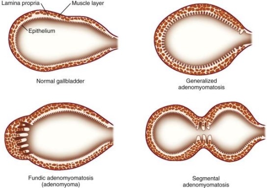 adenomyomatosis-of-gallbladder