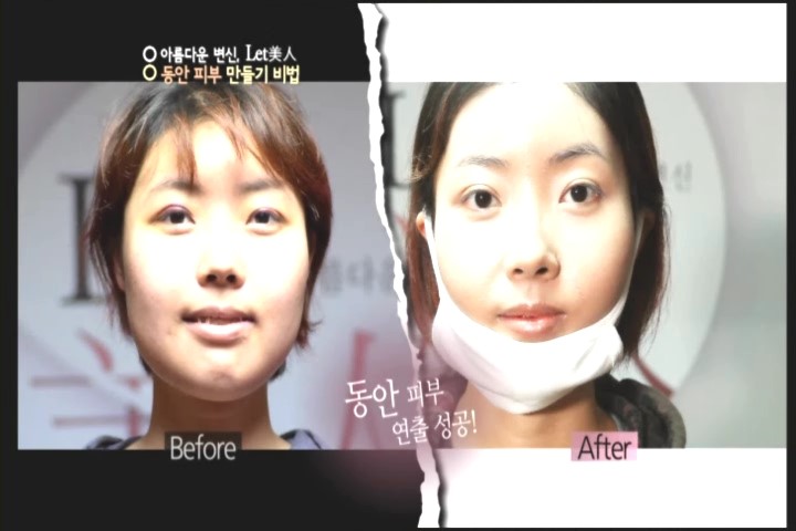 렛미인피부 이미지