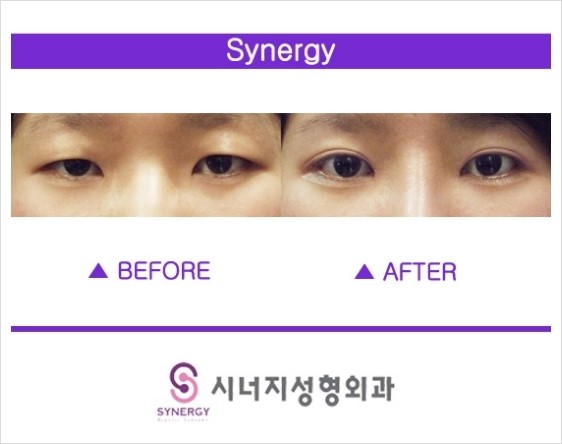 에스라인 이미지