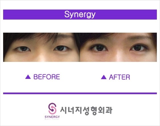 에스라인 이미지