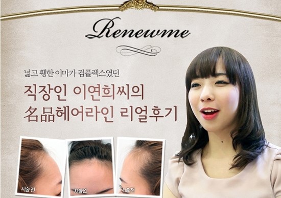 연희헤어라인 이미지