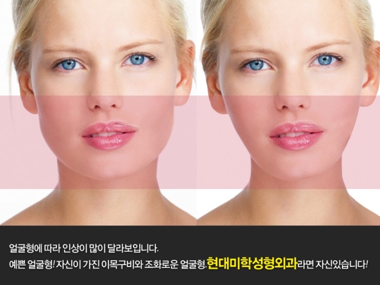 황호성형외과 이미지