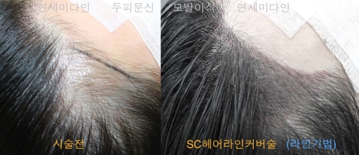정 헤어라인 이미지