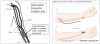Arteriovenous access (AVF and AVG) : 네이버 블로그