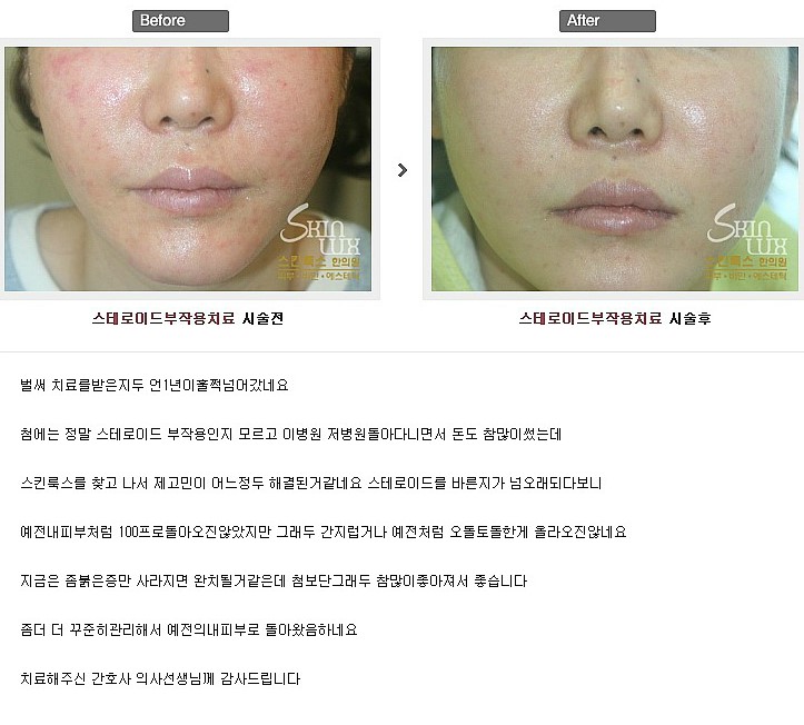스테로이드 연고 부작용 증상과 치료방법 : 네이버 블로그