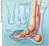 후경골근 기능부전 및 파열((Posterior Tibial Tendonitis / Rupture Syndrome) : 네이버 블로그