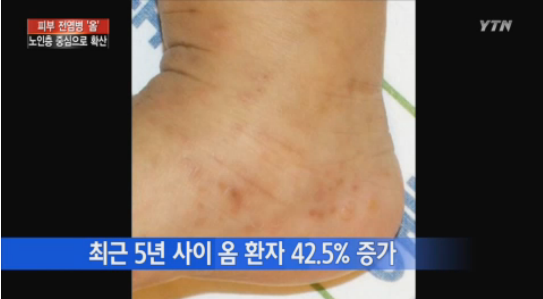 옴증상 초기 사진, 옴 진드기 물린자국 사진 : 네이버 블로그