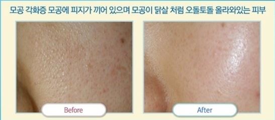 얼굴 모공 줄이는 방법, 얼굴 피지선 제거, 신림 피부과 잘하는 곳, 후한의원 신림점 : 네이버 블로그