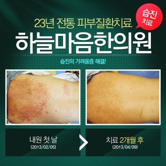습진치료법→습진을 치료하는 →습진치료법!! : 네이버 블로그