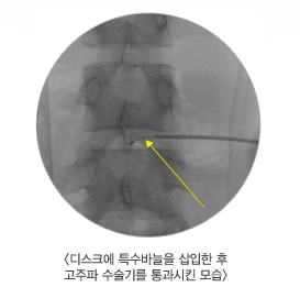 인천고주파 이미지