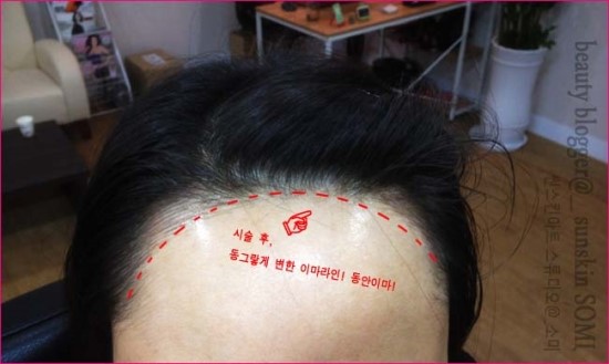 썬헤어라인 이미지
