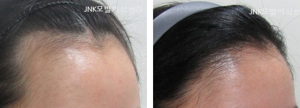 매직헤어라인 이미지