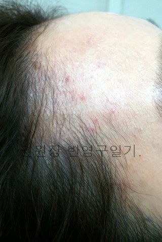 권헤어라인 이미지