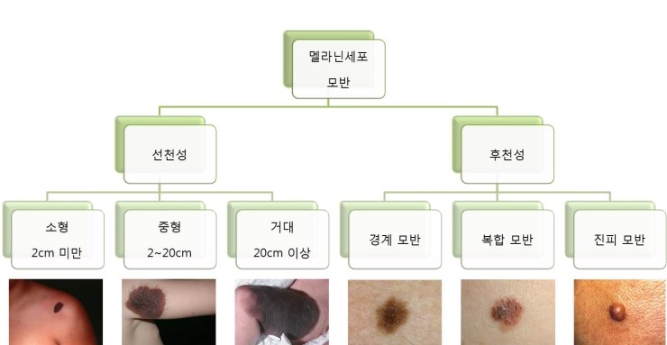 색소(10) 멜라닌세포 모반 (Melanocytic nevus) : 네이버 블로그