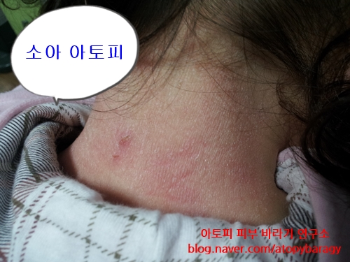 임브레이스 이미지