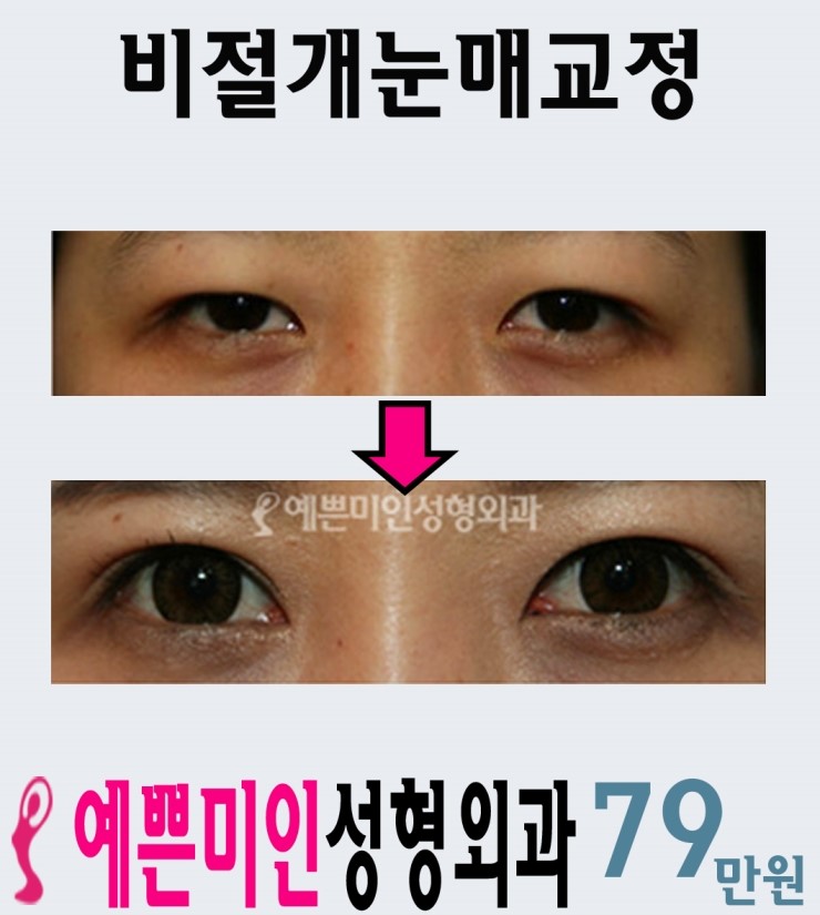 예쁜미인성형외과 이미지