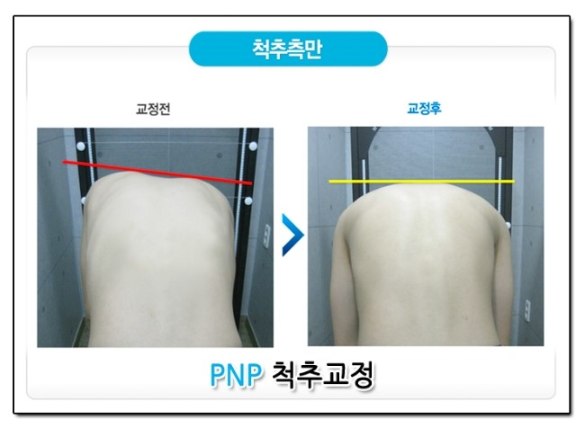 척추교정 이미지