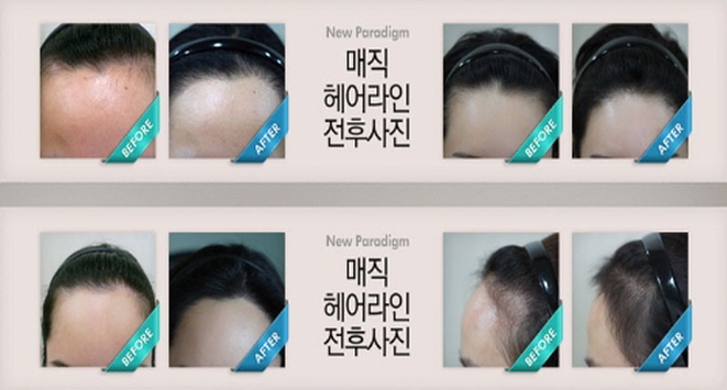매직헤어라인 이미지