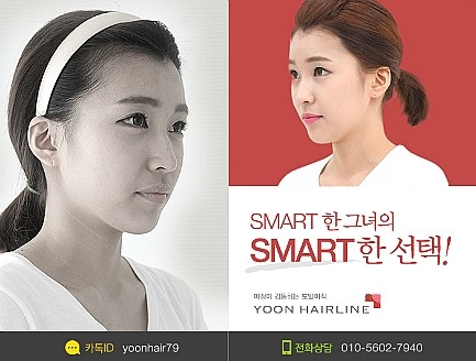 에이스 헤어라인 이미지