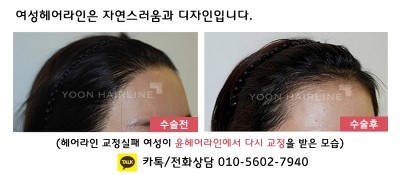 탑헤어라인 이미지
