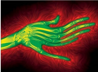외계인 손 증후군(Alien Hand Syndrome) : 네이버 블로그