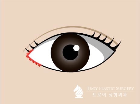 트로이성형외과 이미지