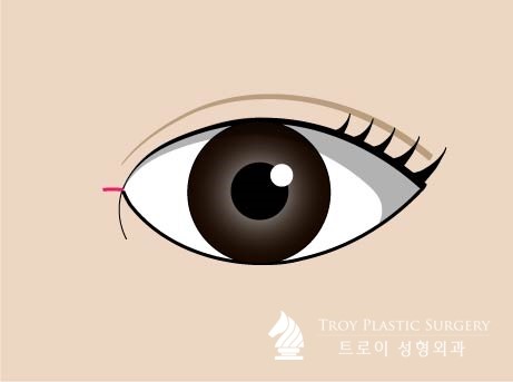 트로이성형외과 이미지