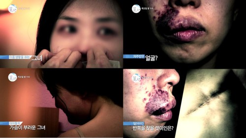 렛미인피부 이미지
