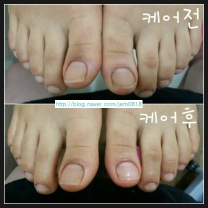 복대패 이미지