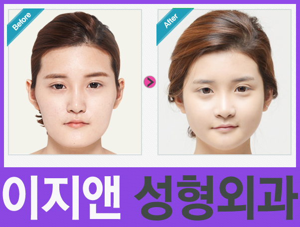 이지성형외과 이미지