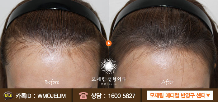 헤어라인 이미지
