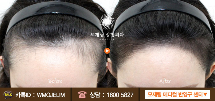 헤어라인 이미지