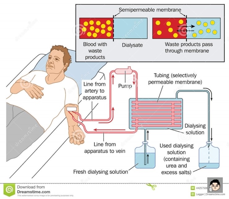 혈액 투석과 투석 환자 생존율,그리고 신장이식 네이버 블로그