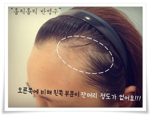 렉스헤어라인 이미지
