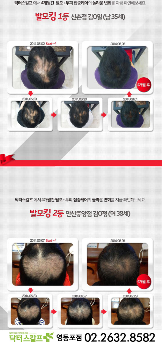 본스칼프 이미지