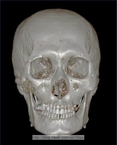 오른쪽 광대의 메쉬형 보형물이 보이는 정면 3D CT