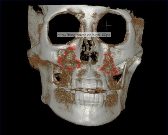 귀족수술 보형물이 외측 상방으로 이동해 안와밑신경 주변에 위치한 3D CT