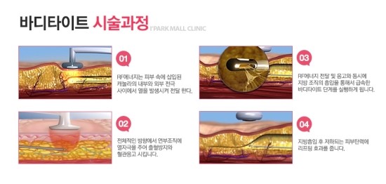 바로바디 이미지