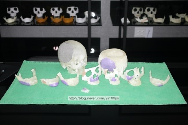 상안면부 중안면부 하안면부로 구분해 출력한 환자 맞춤 안면골 3D프린팅 모형