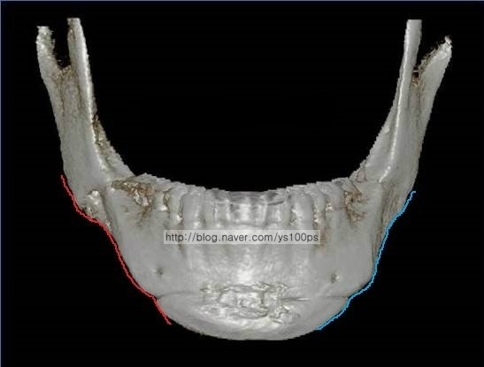 하악골 좌우 비대칭과 턱끝 이차각을 표시한 정면 3D CT