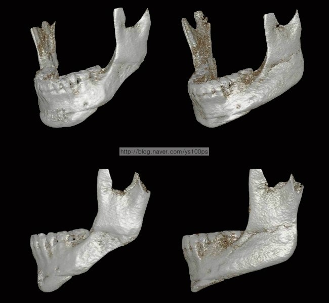 좌측 하악각과 피질골 및 턱끝 재건 전후를 보여주는 3D CT