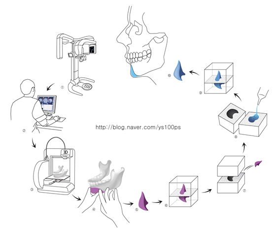 3D 모델과 주형을 이용한 환자 맞춤형 실리콘 보형물 제작 과정