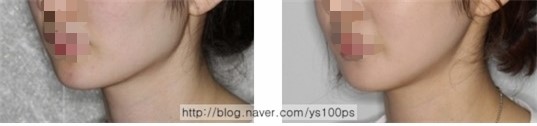사각턱수술 후 정상적으로 회복된 턱선 증례