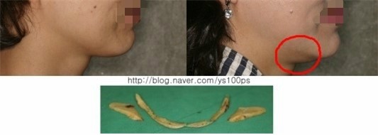 사각턱·피질골 절제 후 이중턱이 관찰된 증례 사진