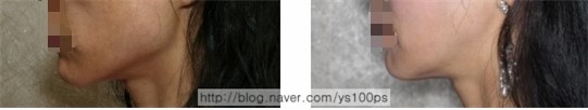 골 절제량이 많았지만 뚜렷한 이중턱이 적은 증례