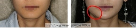 긴곡선·피질골 절제 후 이중턱이 관찰된 증례