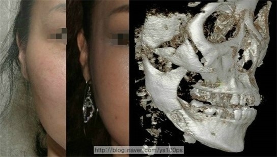 광대축소술 후 골 결손과 함몰이 관찰된 3D CT