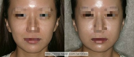 광대·사각턱수술 전후 윤곽 변화를 보여주는 세 번째 증례