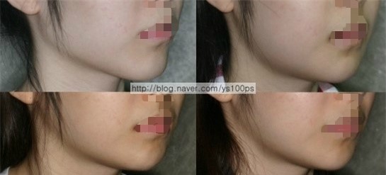 사각턱수술 후 3주부터 3개월까지 부종 변화
